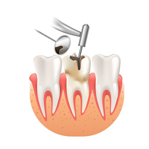 Endodoncia en Barcelona