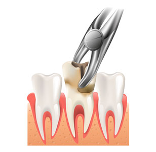 Extracción dental en Barcelona