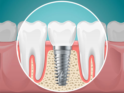 Implante dental de carga inmediata