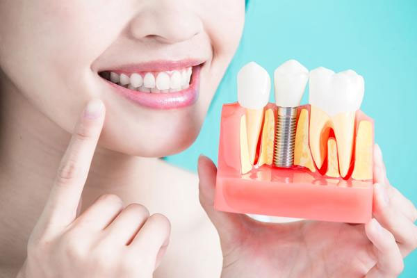 Implantes dentales en Barcelona