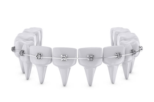 Ortodoncia brakets en Barcelona