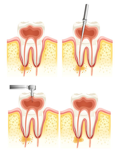 Tratamiento endodoncia en Barcelona