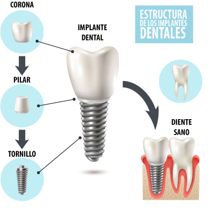Qué es un implante dental