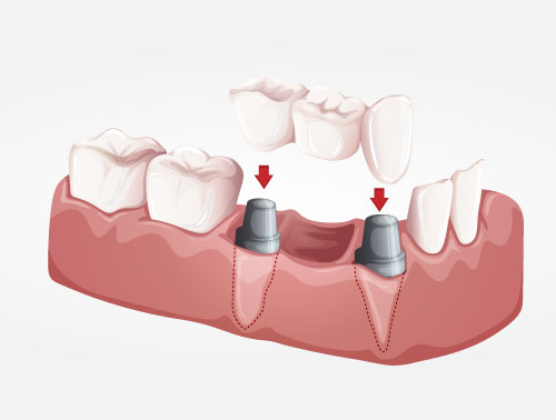Implante dental con puente